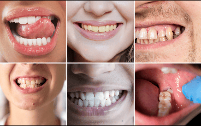 Mantener una buena higiene oral, acudir a revisiones periódicas y prestar atención a cualquier cambio visible sigue siendo la mejor estrategia para prevenir complicaciones y conservar una sonrisa saludable. CANVA