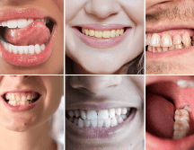 Mantener una buena higiene oral, acudir a revisiones periódicas y prestar atención a cualquier cambio visible sigue siendo la mejor estrategia para prevenir complicaciones y conservar una sonrisa saludable. CANVA