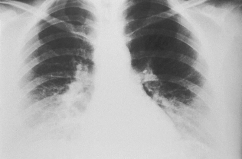 La forma de detectar un nódulo en el pulmón es a través de una radiografía del tórax o en una exploración por TC. &nbsp;UNSPLASH / CDC